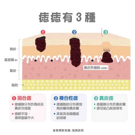 痣的形成原因|痣變大、痣多或長毛會變皮膚癌？認識痣的形成與原因